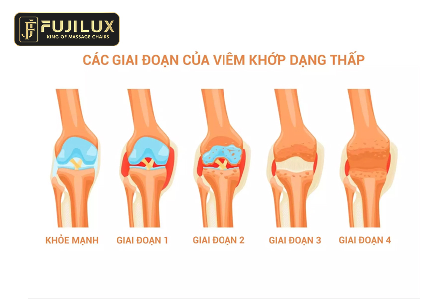 4 giai đoạn của bênh viêm khớp dạng thấp