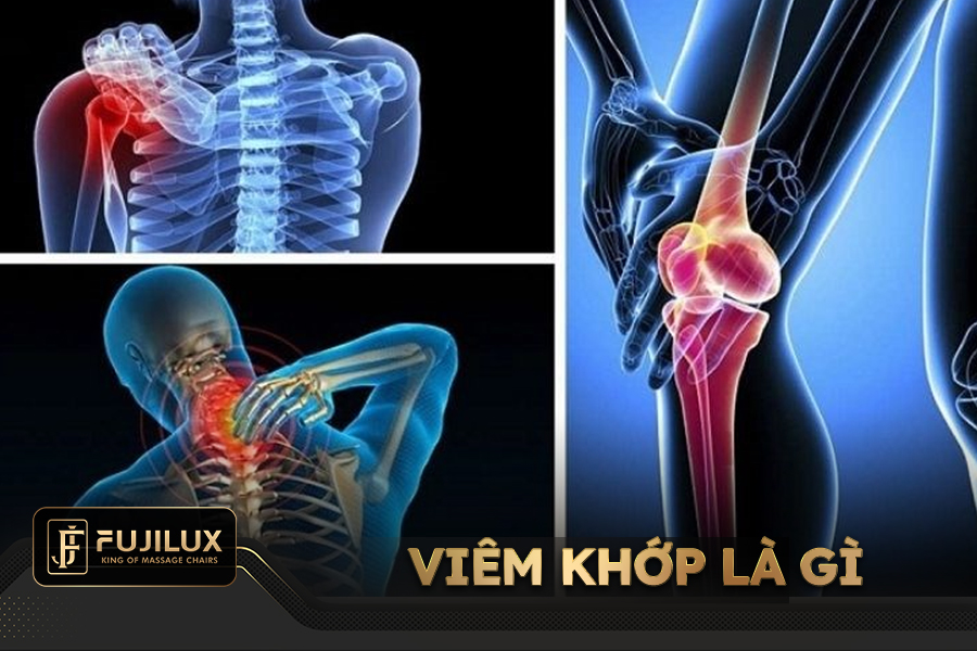 Bệnh viêm khớp là gì?