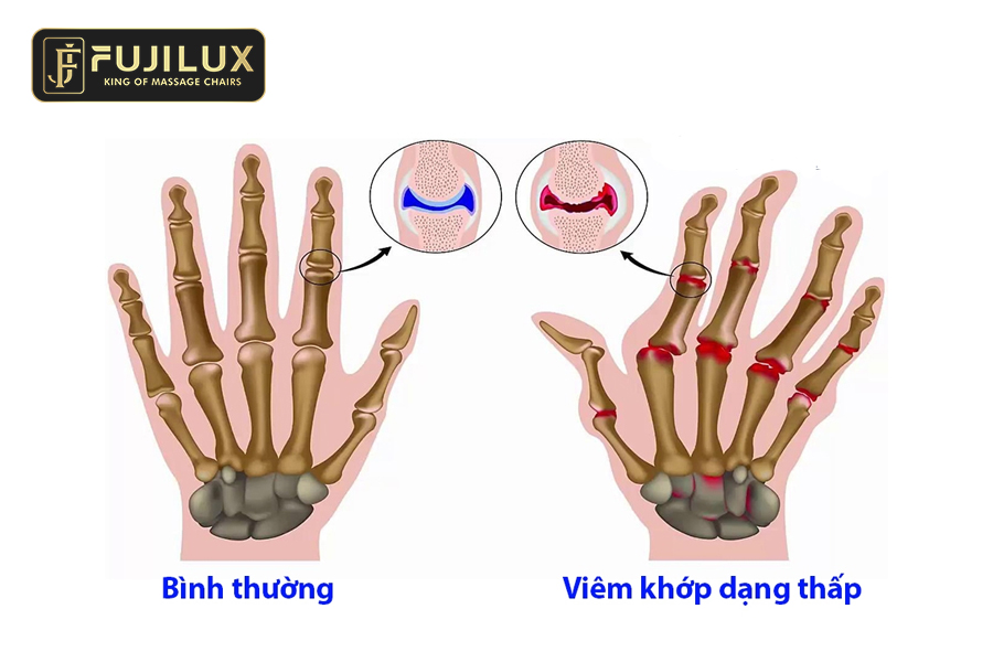 Mô phỏng xương của bênh nhân mắc bênh viêm khớp dạng thấp